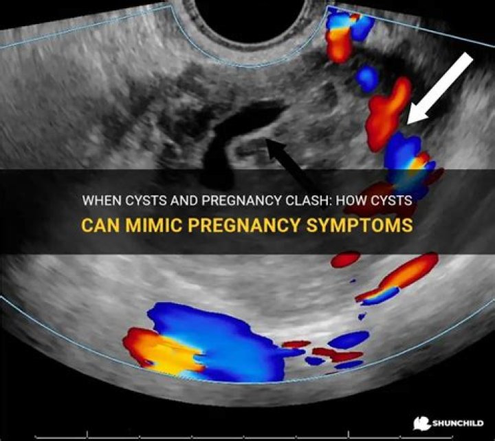 Can a cyst be confused with pregnancy?