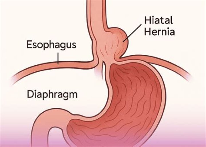 Can a hiatal hernia cause right upper quadrant pain?