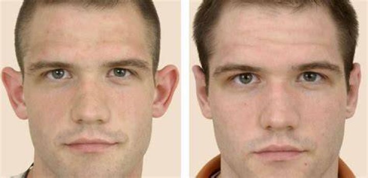 Can adults get their ears pinned back?