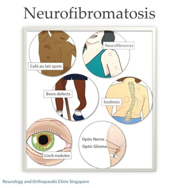 Can neurofibromatosis be prevented?