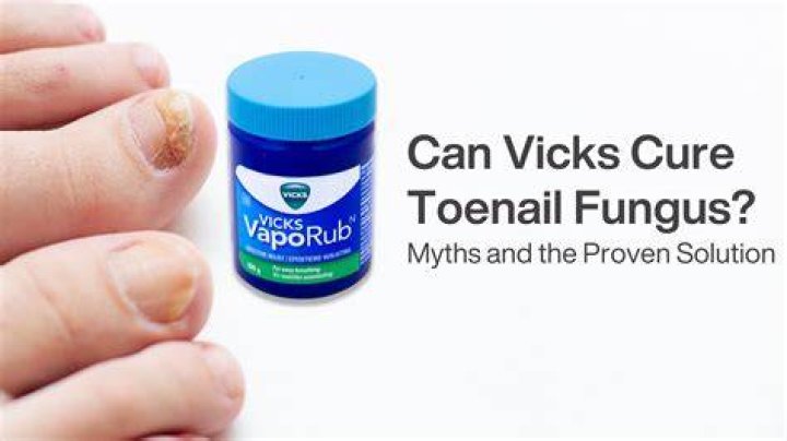 Can Vicks cure toenail fungus?