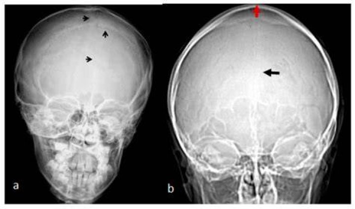 Can you grow out of West syndrome?