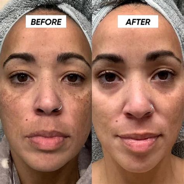 Does exfoliating make hyperpigmentation worse?