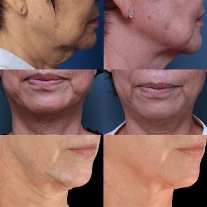 Does micro needling help turkey neck?