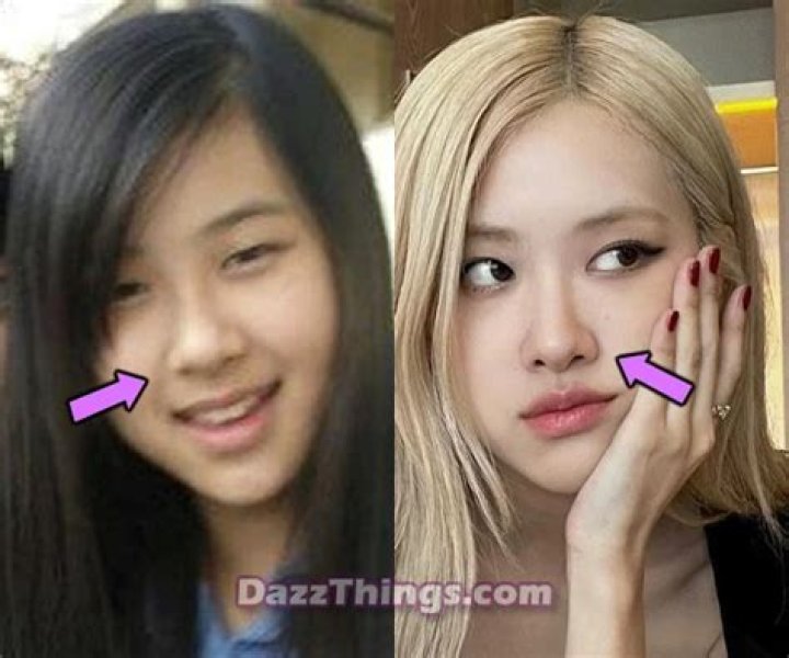 Does Rose have plastic surgery?