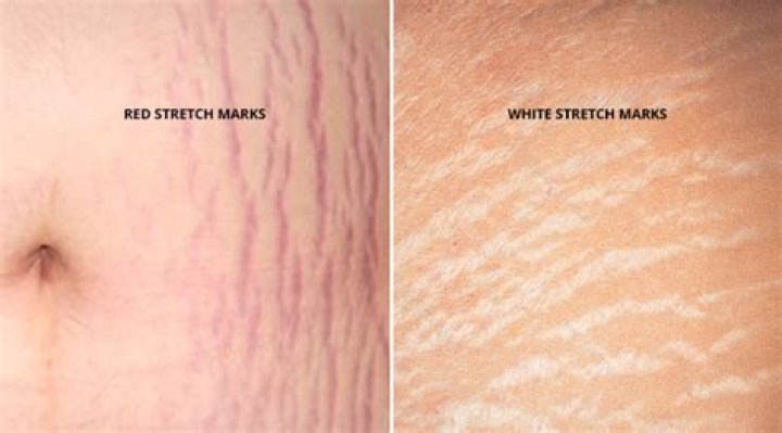 How long do stretch marks take to turn white?
