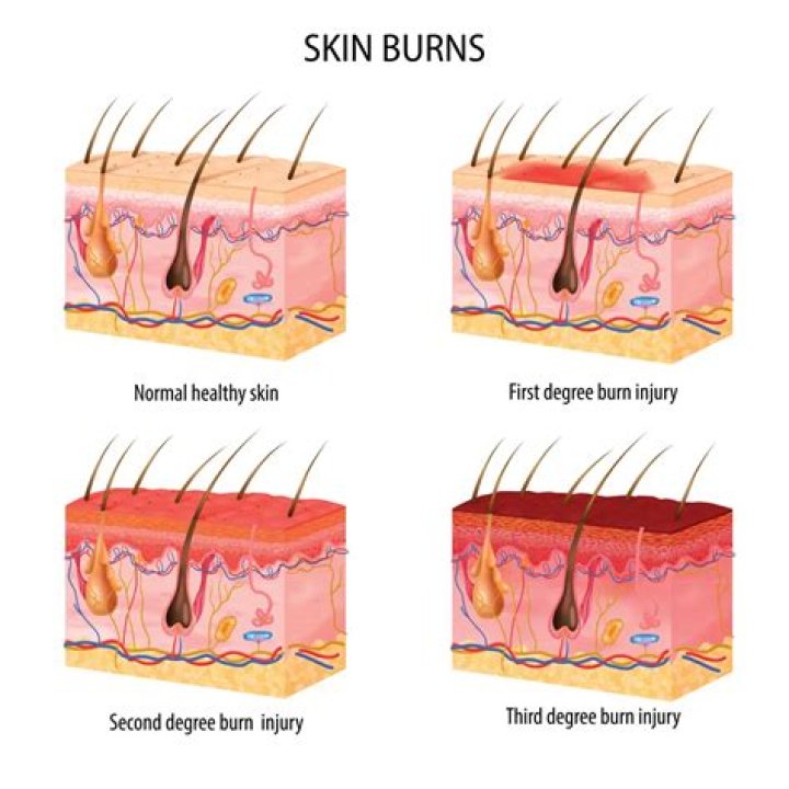 How long does first degree burn pain last?