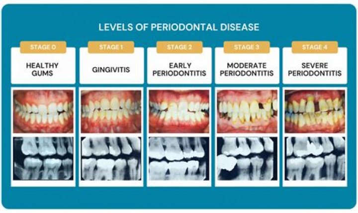 How long does gingivitis take to turn into periodontitis?