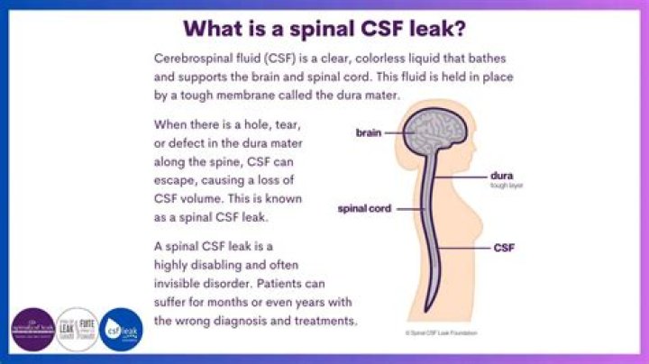 How rare is a CSF leak?