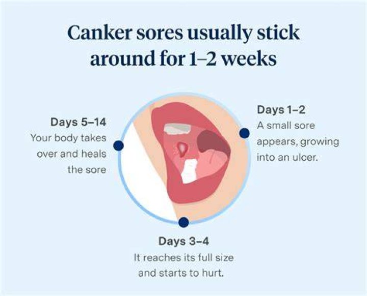 Should I worry about canker sores?