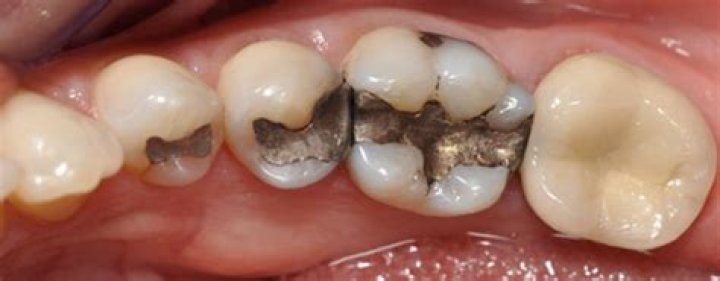 What are black fillings made of?