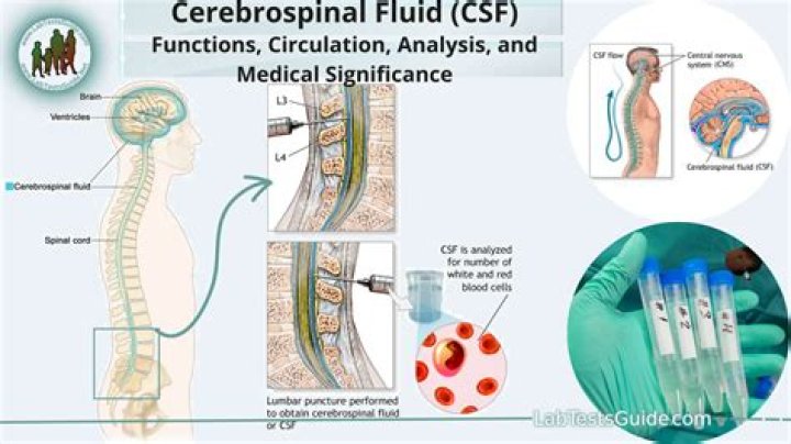 What does inflammation in spinal fluid mean?