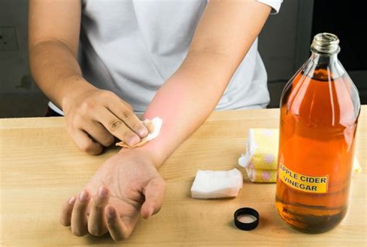 What happens if you leave apple cider vinegar on your skin?