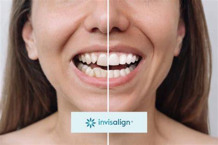 What happens when you finish Invisalign?