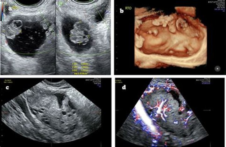 What is a mass on an ultrasound?