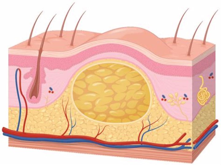 What is inside a lipoma?