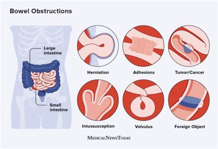 What is the difference between bowel obstruction and impaction?