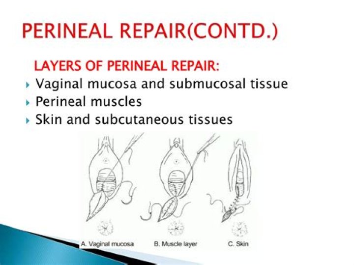 What is the incision through the vaginal wall and perineum?