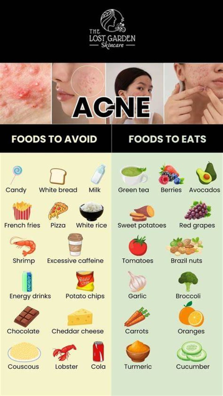 What should I avoid eating for acne?