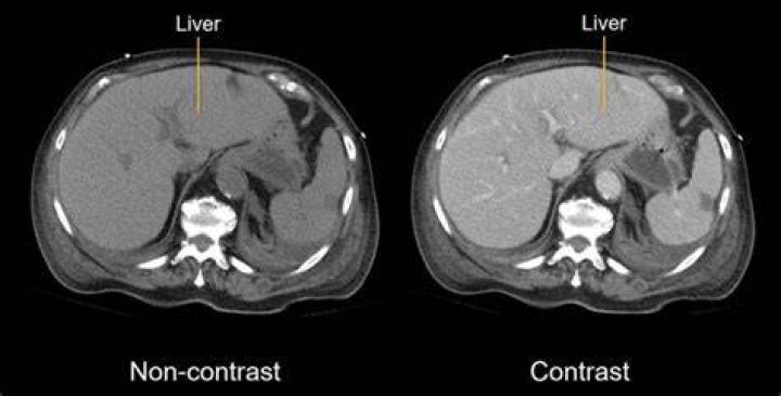 What should I do after CT with contrast?