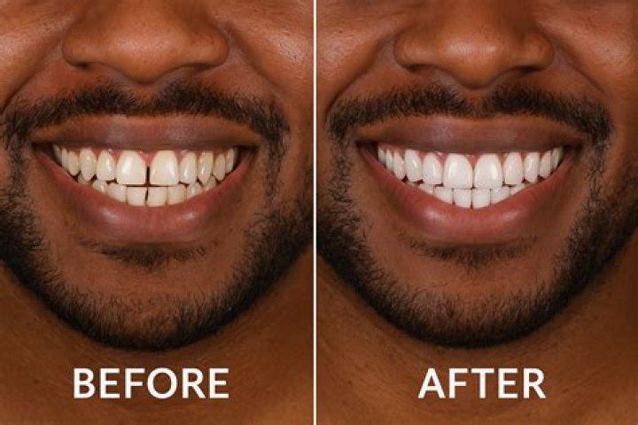 What should I do before getting veneers?