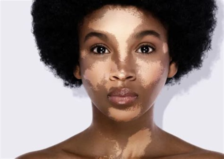 What vitiligo looks like?