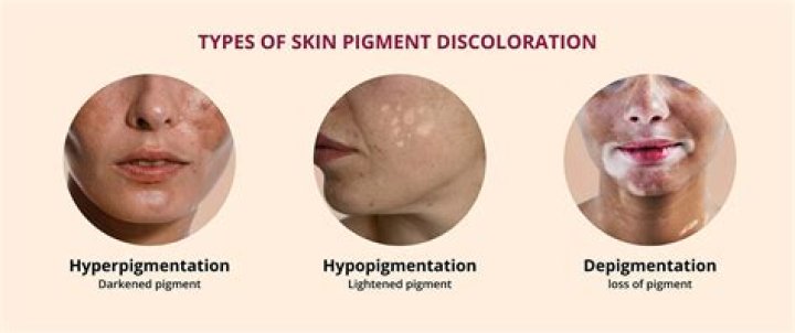 Why is my hyperpigmentation spreading?