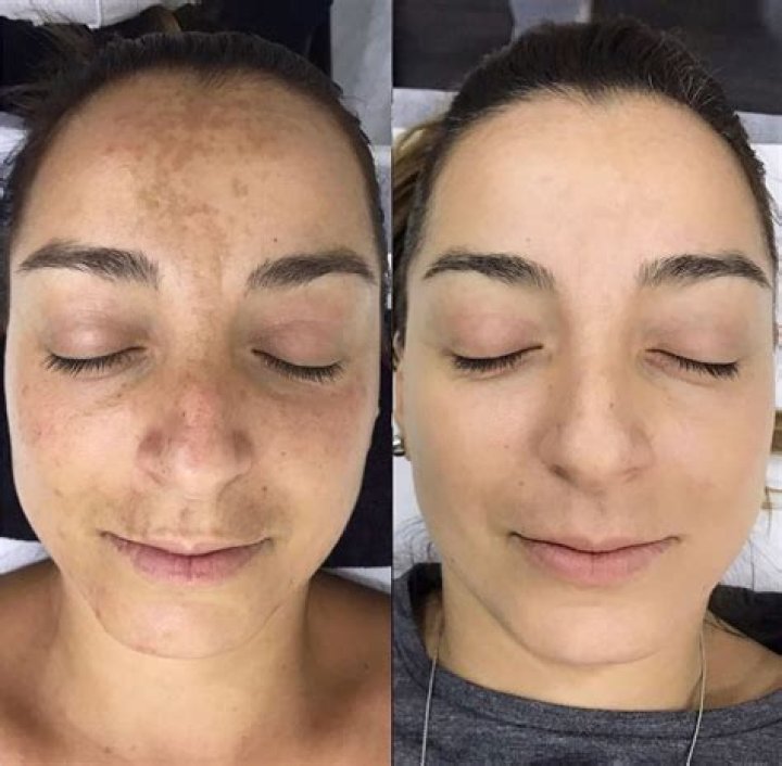Will microdermabrasion remove freckles?
